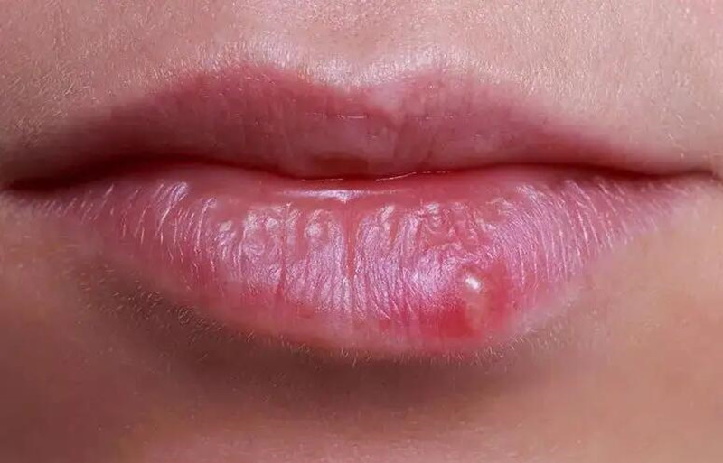 紋唇后起泡怎么辦？南寧紋唇培訓(xùn)學(xué)校教你方法